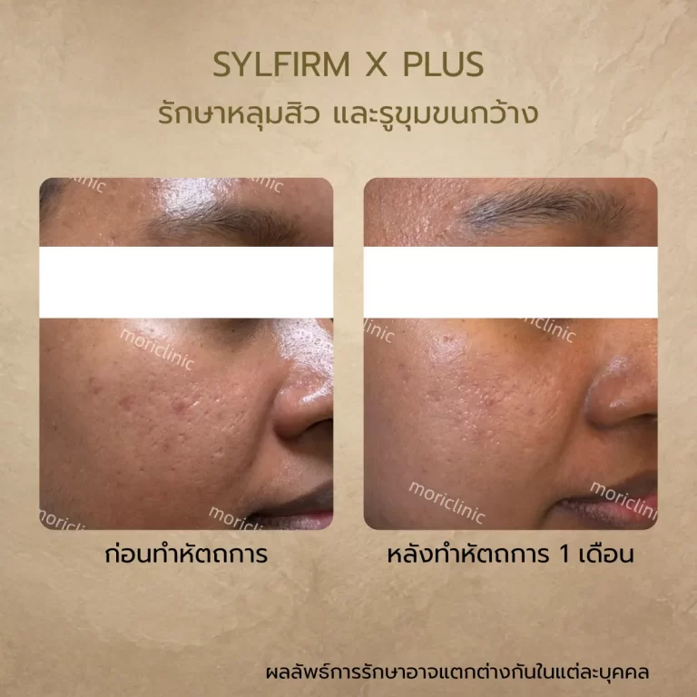 รีวิว Sylfirm X Plus ก่อนและหลังรักษา Mori Clinic