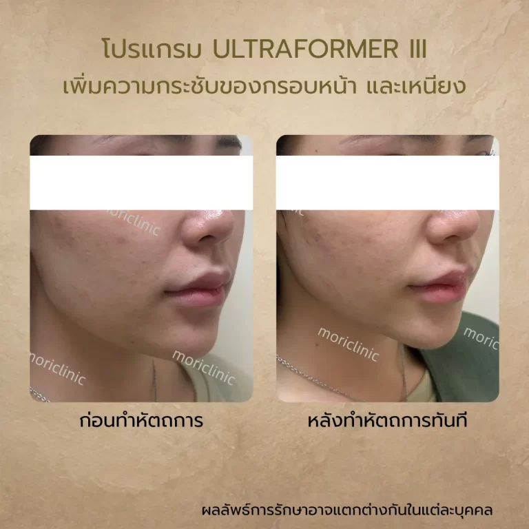 รีวิว Ultraformer III ก่อนและหลังรักษา Mori Clinic