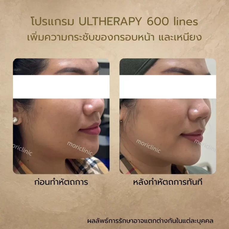 รีวิว Ultherapy 600 lines ก่อนและหลังรักษา Mori Clinic
