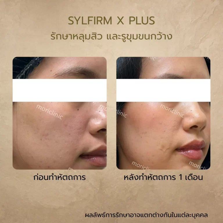 รีวิว Sylfirm X Plus ก่อนและหลังรักษา Mori Clinic