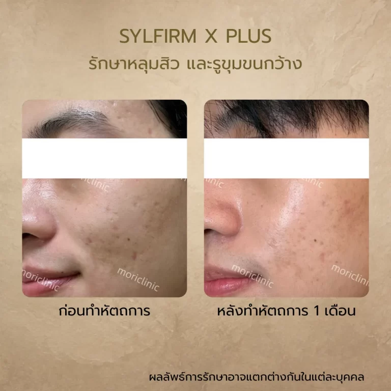 รีวิว Sylfirm X Plus ก่อนและหลังรักษา Mori Clinic