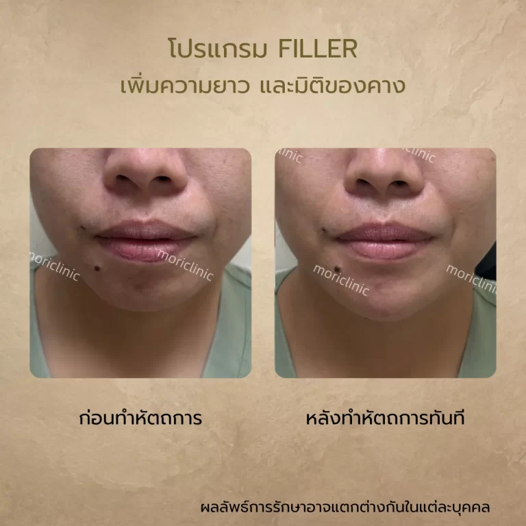 รีวิว Filler ก่อนและหลังรักษา Mori Clinic