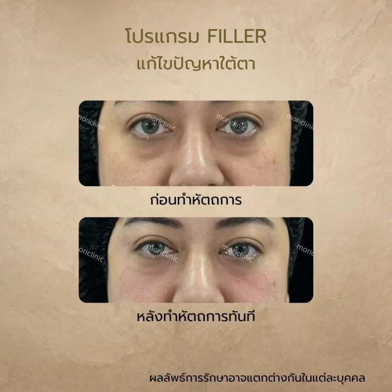 รีวิว Filler ใต้ตา ก่อนและหลังรักษา Mori Clinic