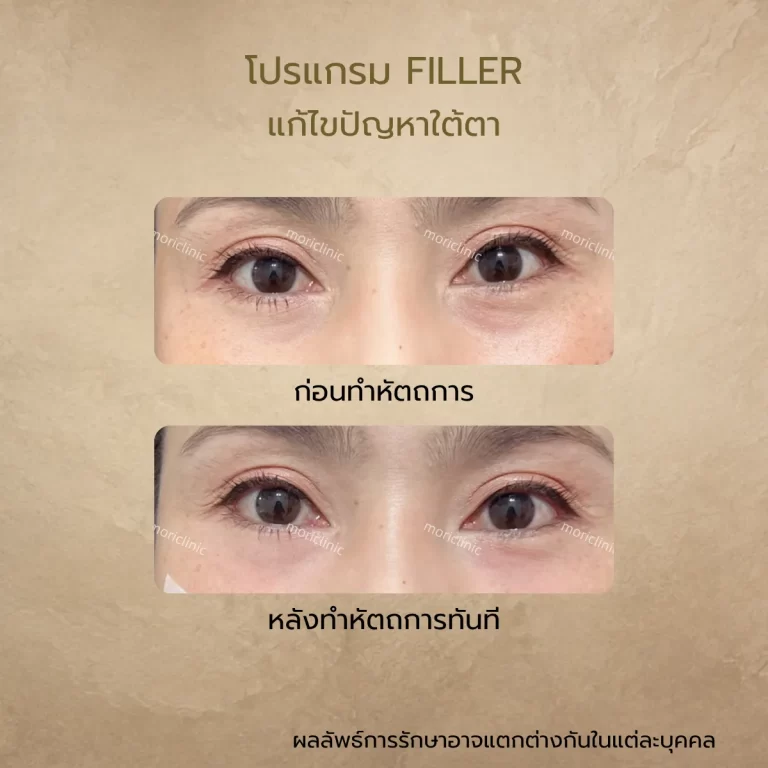 รีวิว Filler ใต้ตา ก่อนและหลังรักษา Mori Clinic